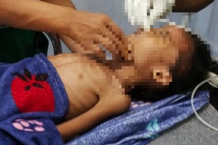 Haji Uma Tanggung Biaya Pendamping Penderita Gizi Buruk