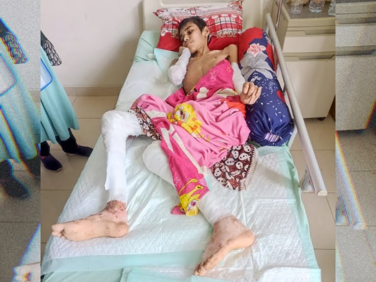 Sempat Terbaring Dirumah Dengan Luka Bakar Yang Parah, Kini Farizan Dilarikan Kerumah Sakit di Medan