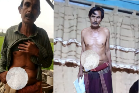 Pria Lansia Butuh Biaya Untuk Kolostomi, Atau Operasi Sekali Lagi